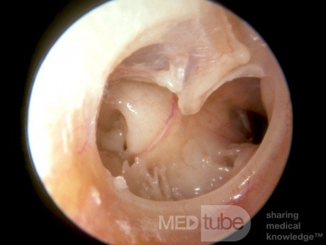 Subtotale Trommelfellperforation - die Öffnung der Tuba auditiva 