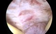 Hysteroskopische Endometriumablation