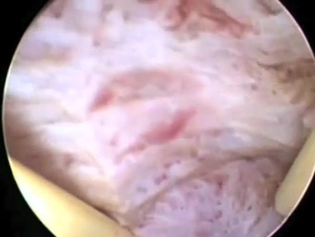 Hysteroskopische Endometriumablation