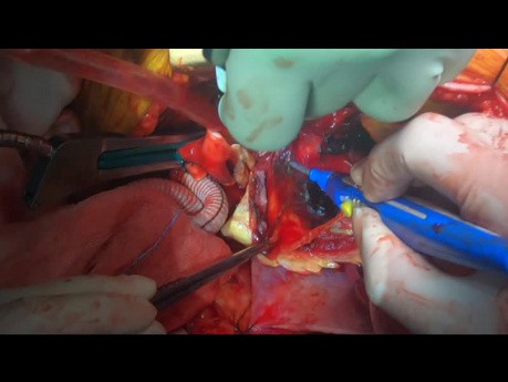 Rupturiertes Aortenaneurysma des Bogens und der aufsteigenden Aorta