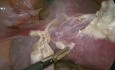 Laparoskopische totale Hysterektomie bei Kaiserschnitt-Narbenschwangerschaft