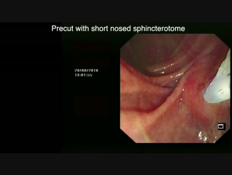 Endoskopische Retrograde Cholangiopankreatikographie (ERCP)