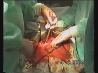 Operation für -  Exstirpation des Magenstumpfes