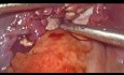 Myomectomy eines 15 cm großen fibroiden Gebärmuttermyoms mit Hilfe eines Morcellations-Bergebeutel