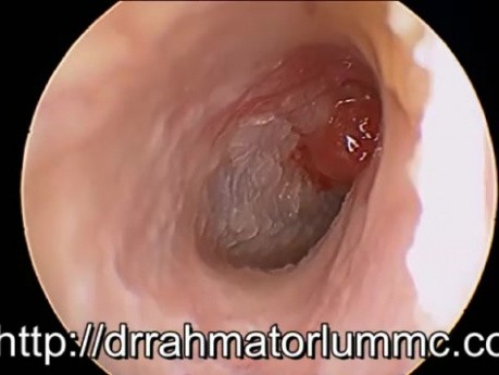 Attischer Polyp