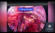 Peritonektomie des hinteren Kompartiments bei Endometriose