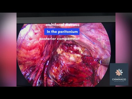 Peritonektomie des hinteren Kompartiments bei Endometriose