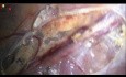 Wie man für eine arterienerhaltende laparoskopische Varikokelektomie präpariert