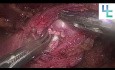 Reimplantation des Harnleiters bei Nierentransplantation