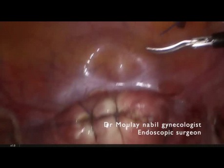 Sichere schnelle laparoskopische Myomektomie