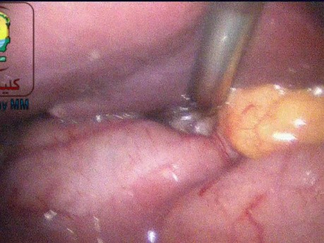 Pankreatitis