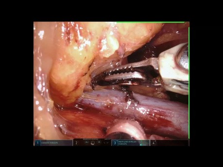Großer Mediastinaltumor