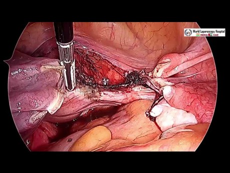 Totale laparoskopische Hysterektomie und bilaterale Salpingo-Oophorektomie 