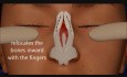 Rhinoplastik - Animation