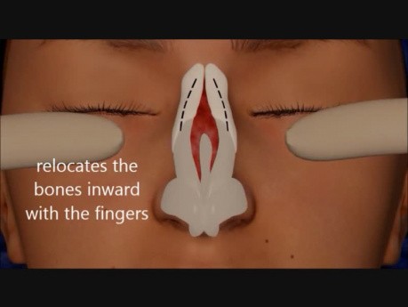 Rhinoplastik - Animation
