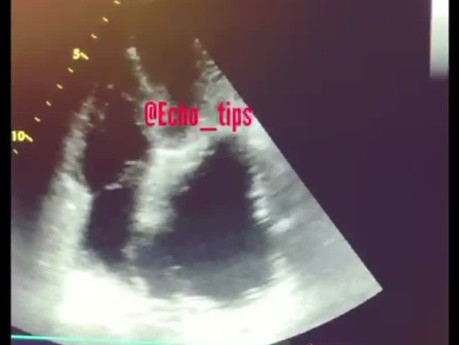 Aortenannurysma in der Echokardiographie