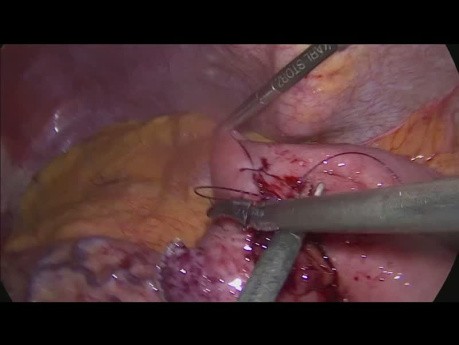 Umwandlung von OAGB (Ein-Anastomose-Magenbypass) in RYGB (Roux-en-Y-Magenbypass)