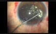 Stumpfes Augentrauma, Pars Plana Anterior Vitrektomie, Phako, CTR und IOL Implantation