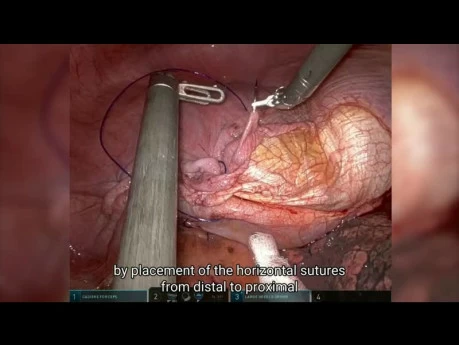 Die Verwendung von selbstfixierendem Quill®-Nahtmaterial (Barbed Suture) zur robotischen Zwerchfellplikation