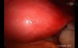Laparoskopische Myomektomie 