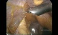 Laparoskopische Cholezystektomie bei einem Patienten mit offener Leberoperation in der Anamnese