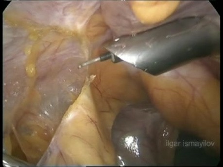Laparoskopische Cholezystektomie bei einem Patienten mit offener Leberoperation in der Anamnese