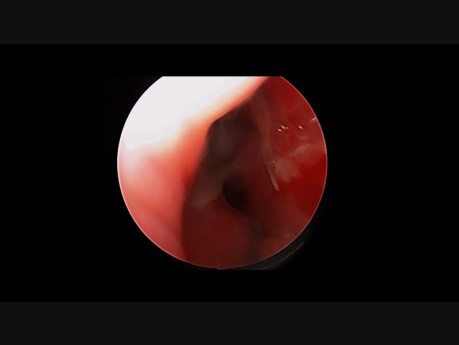Verschluss der Septumperforation