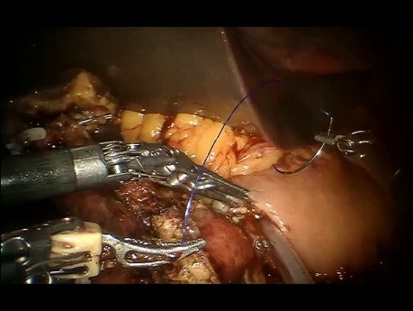 Wie bilden wir eine Pankreas-Magenanastomose während des robotergestützten und laparoskopischen Whipple-Verfahrens?