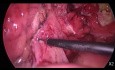 Laparoskopische Notfallchirurgie bei akuter Divertikulitis - Hartmann-Operation.