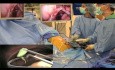 Assistenzausbildung mit laparo-endoskopischer Single-Site-Cholezystektomie (LESS) mit Epiduralanästhesie