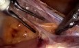Totale laparoskopische Hysterektomie – Standardtechnik