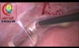 Ist es besser, nach der Entfernung der Gallenblase aus dem Gallenblasenbett eine Adhäsiolyse der entfernten Verwachsungen durchzuführen oder nicht?