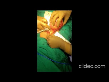 Chirurgie der Mesenterialzyste