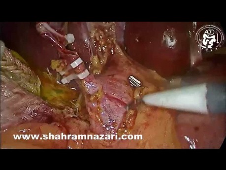 Explorative Laparoskopie des Choledochus, Sphinkterotomie und Stent des Choledochus