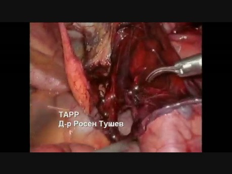Reparatur eines rechten Leistenbruchs – TAPP