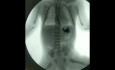 Ösophagusatresie mit distaler tracheoösophagealer Fistel