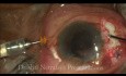 Behandlung einer Linsenluxation - Phakofragmentation