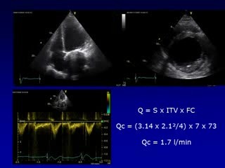 Echokardiographische Messung vom Herzzeitvolumen