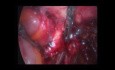 Laparoskopische Hysterektomie zur Behandlung der Endometriose