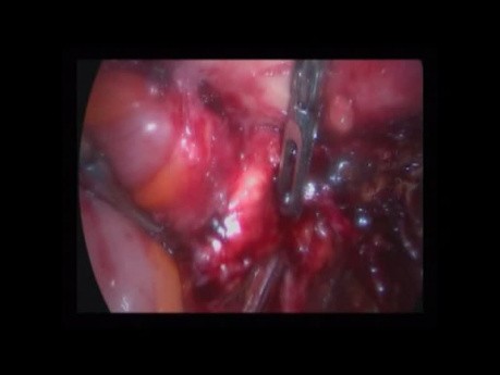 Laparoskopische Hysterektomie zur Behandlung der Endometriose