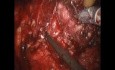  Prostatektomie ohne die Nerven Ausschnitt