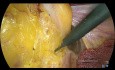 Laparoskopische totale mesorektale Exzision ohne Stoma, Turnbull-Cutait Pull-Through Rektumkarzinomchirurgie