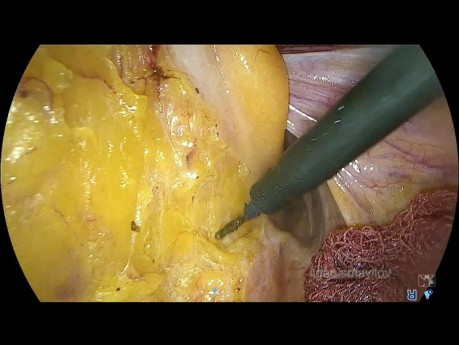 Laparoskopische totale mesorektale Exzision ohne Stoma, Turnbull-Cutait Pull-Through Rektumkarzinomchirurgie