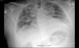 COVID-19- Röntgen-Thorax (2)
