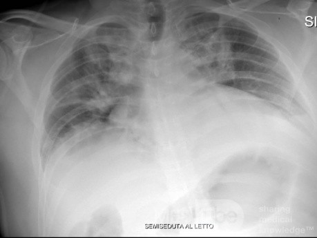 COVID-19- Röntgen-Thorax (2)
