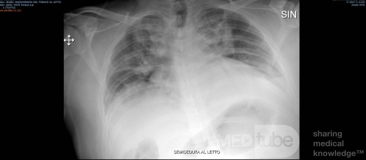 COVID-19- Röntgen-Thorax (2)