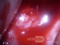 Zervikales Adenokarzinom (Carcinoma glandulare colli uteri)