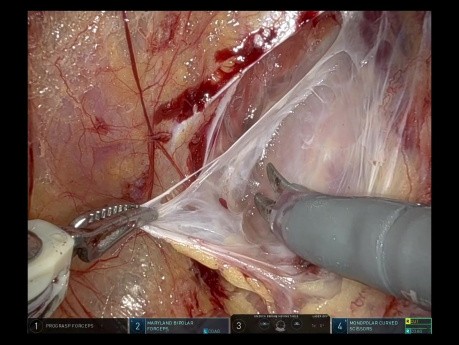 SAFE-Technik (Saline-Assisted Fascial Exposure) zur Nervenschonung während roboterassistierter radikaler Prostatektomie (RARP)