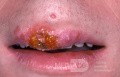Herpes-simplex-Virus-Infektion auf der Oberlippe - Frühstadium