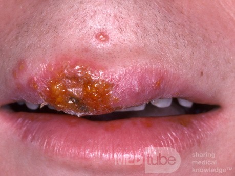 Herpes-simplex-Virus-Infektion auf der Oberlippe - Frühstadium